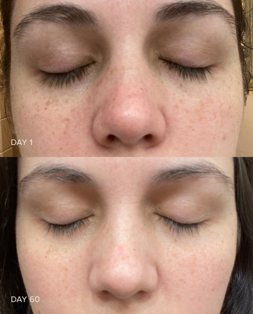 Vitamin C Serum Before and After