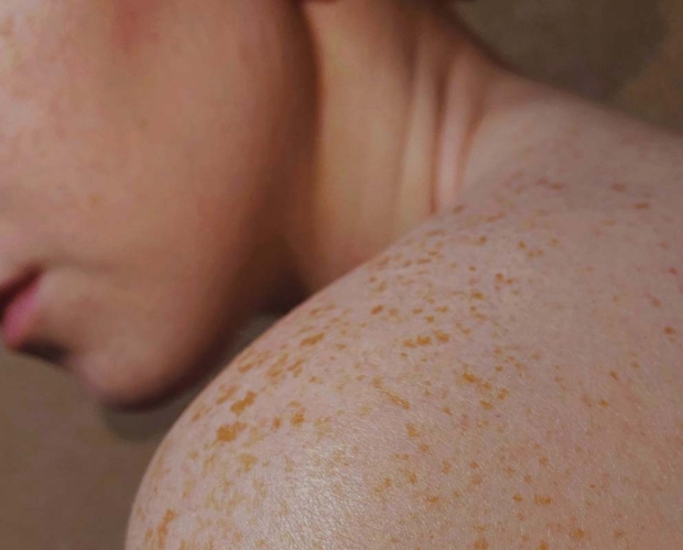 Sensitive skin care tips